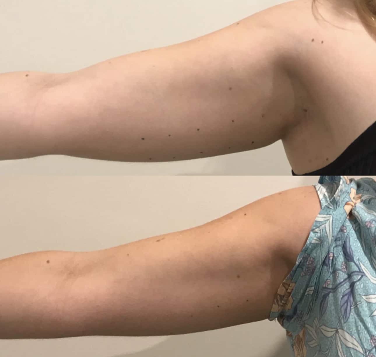 Arms Before and After