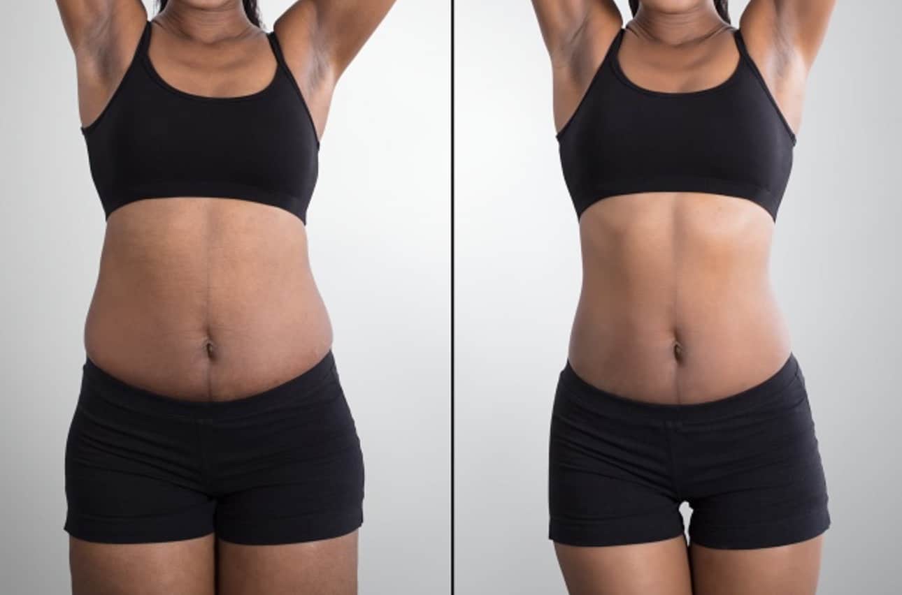 Stomach Before and After