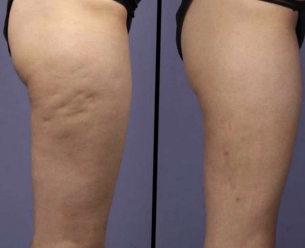 Thigh Before and After
