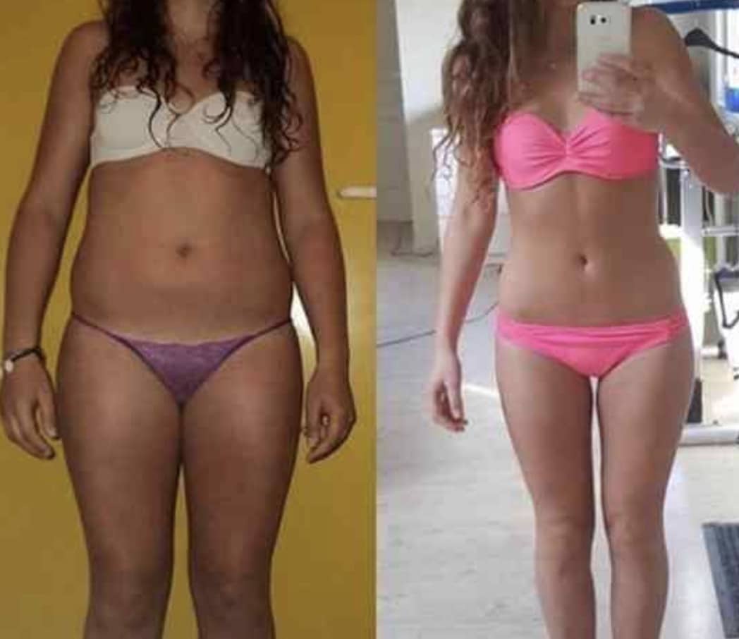Sonic Lift Cellulite Remover Before and After Results