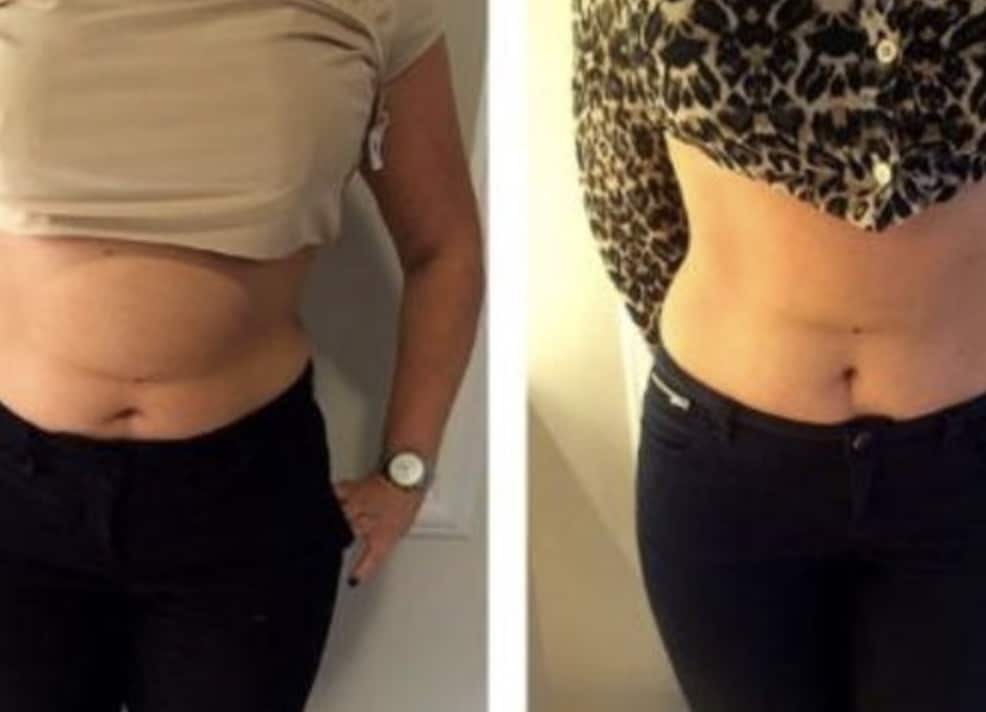 Ultracavitat Fat & Cellulite Remover Before and After Results