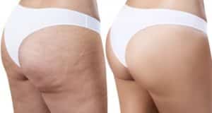 Butt Cellulite