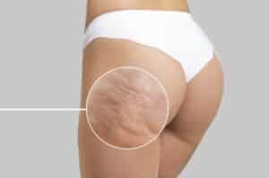 Cellulite