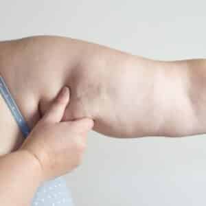 Cellulite on Arms