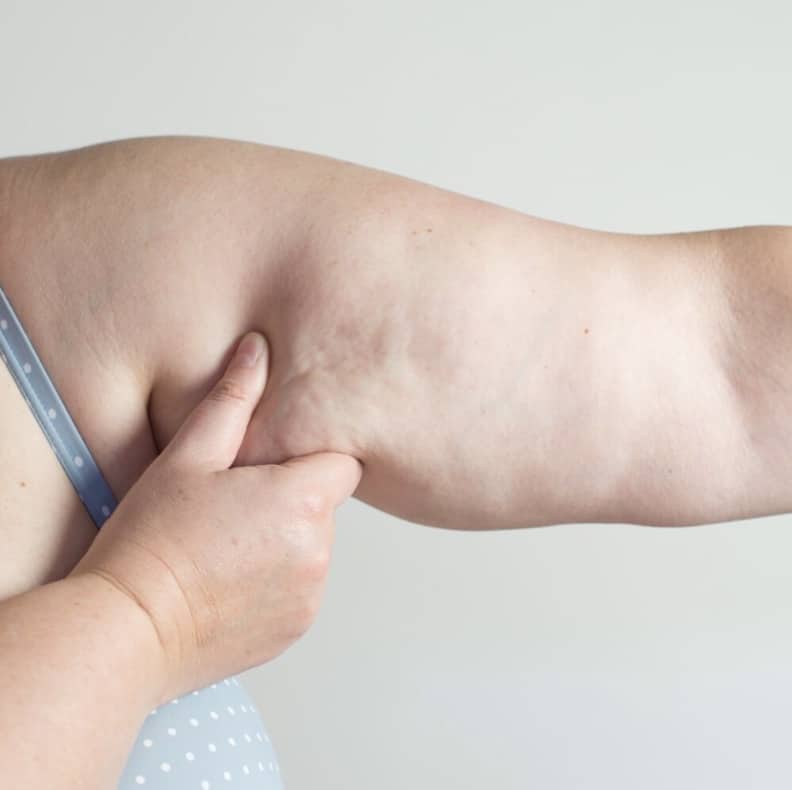 Cellulite on Arms