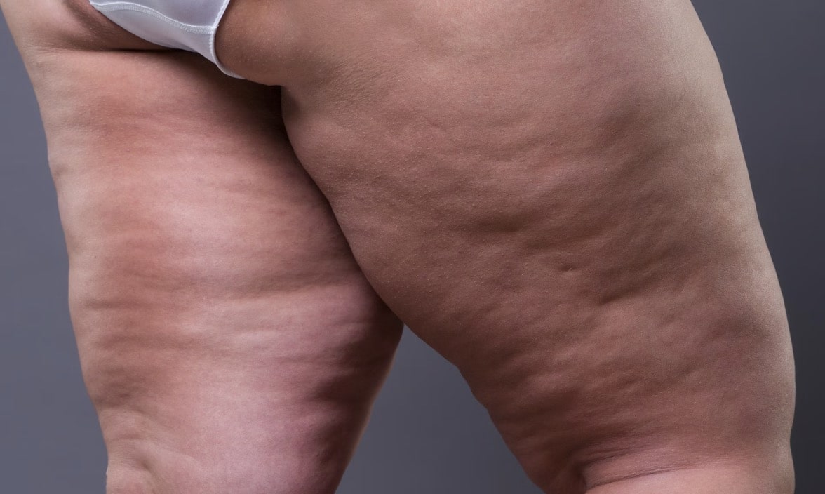 Cellulite on Thighs
